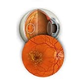 Macular degeneration