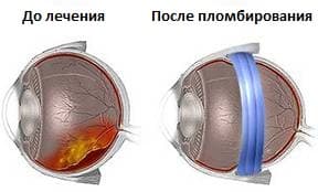 Retinal detachment treatment