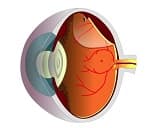 Retinal detachment