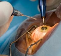 Памятка пациенту после операции по пересадке роговицы глаза 