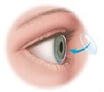 Пересадка роговицы глаза