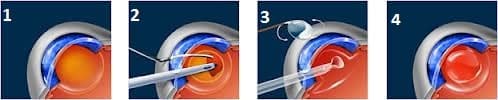 Cataract phacoemulsification surgery