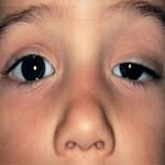 Ptosis and its treatment