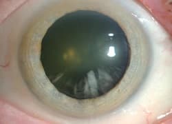 Начальная катаракта — что это, причины, симптомы и лечение