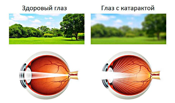 Симптомы катаракты глаза (помутнения хрусталика)