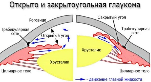 Открытоугольная и закрытоугольная глаукомы