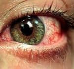 Глазные капли при кровоизлиянии