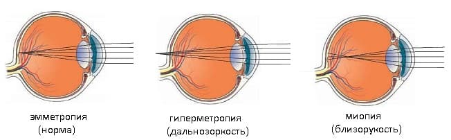 Нарушение рефракции глаза