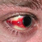 Травма глаза симптомы
