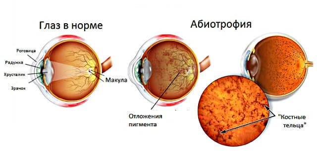 pigmentnaya abiotrofiya