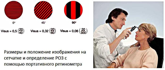 Ретинальная острота зрения (РОЗ)