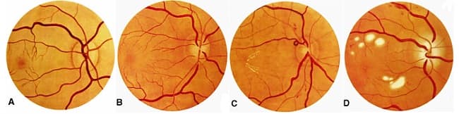 Ангиопатия сетчатки глаза. Симптомы и лечение в центре Тарус