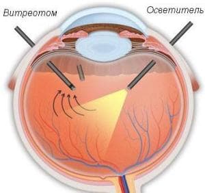 vitreotom