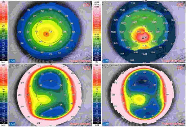 Диагноз по кератотопографии