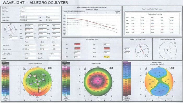Результаты кератотопографии