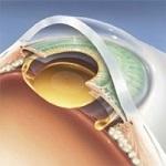 Posterior Capsule Opacity